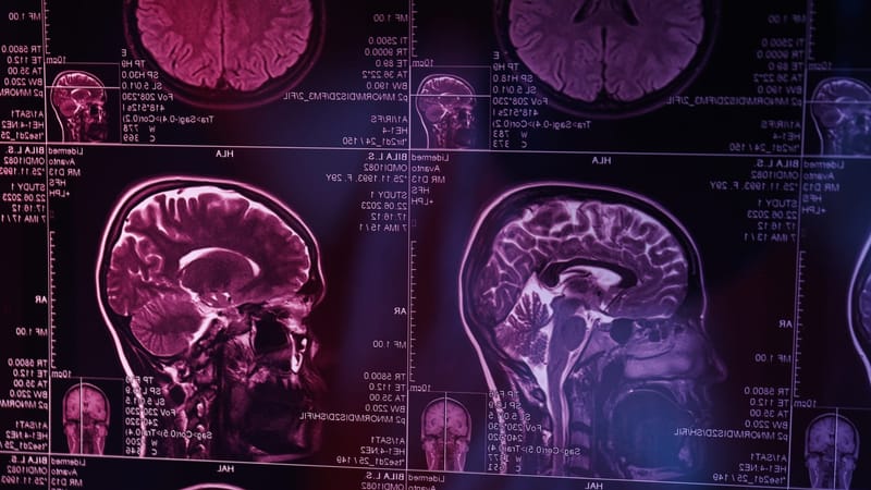 COVID-19 și îmbătrânirea cerebrală: Când timpul curge mai repede pentru creierul tău imagine postare
